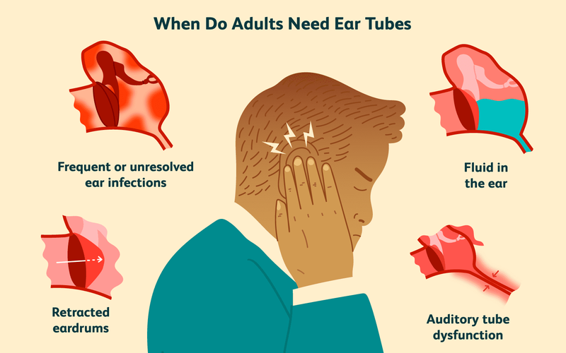 Tác dụng “bất ngờ” của phương pháp đặt ống thông khí màng nhĩ 2