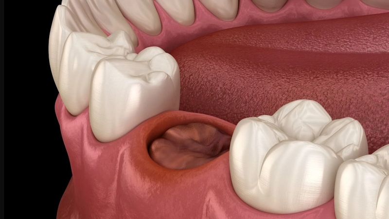 Tác dụng của cục máu đông sau khi nhổ răng 3