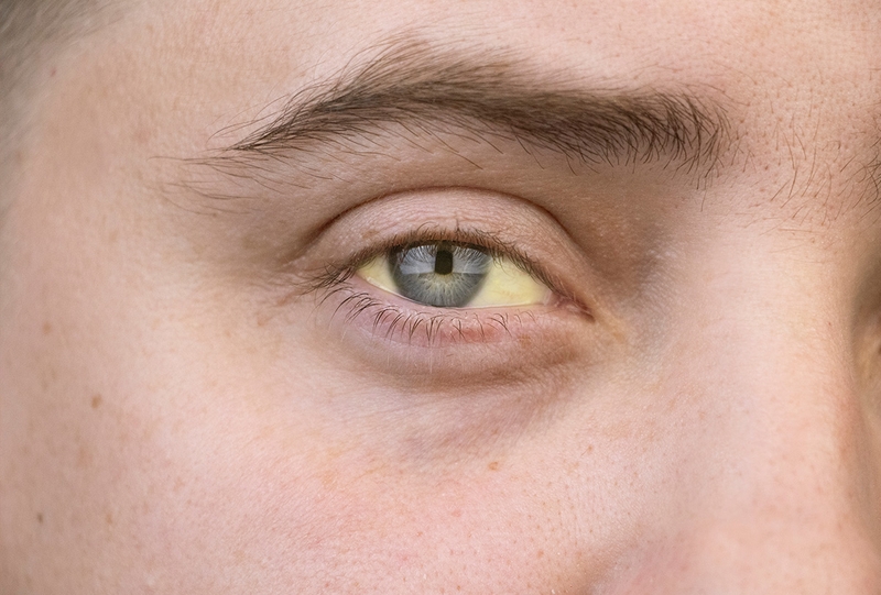 Tác dụng của huyệt Đởm Du trong việc hỗ trợ điều trị bệnh3