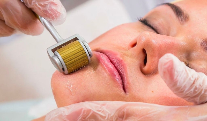 Tác dụng của lăn kim trị sẹo rỗ? Có thực hiện tại nhà được không? 2