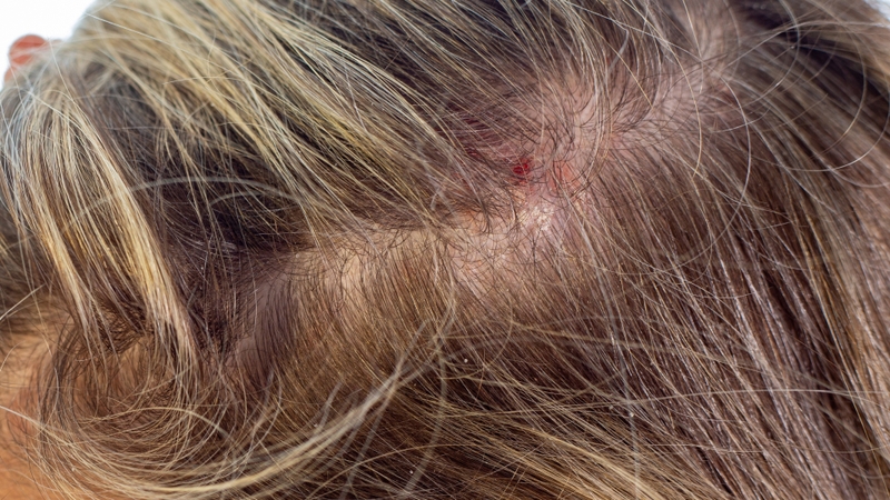 Gừng có tính nóng, có thể gây kích ứng mạnh, làm trầm trọng thêm các vết trầy xước hoặc viêm nhiễm