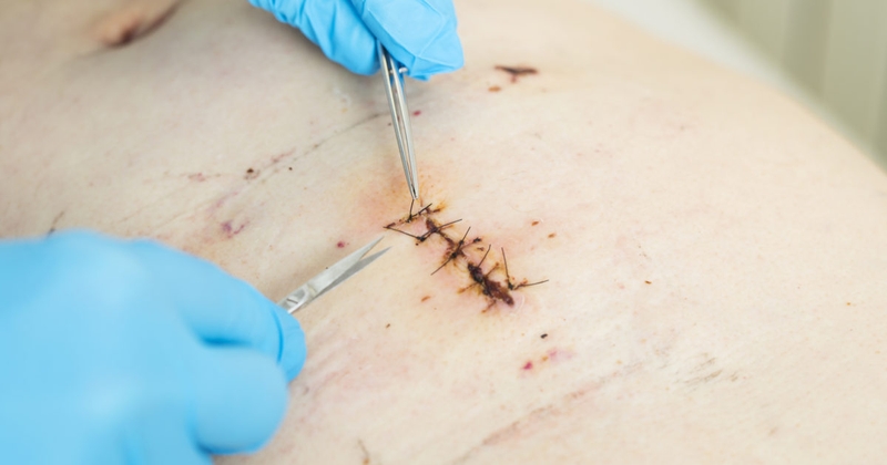 Tác dụng không mong muốn của phẫu thuật3