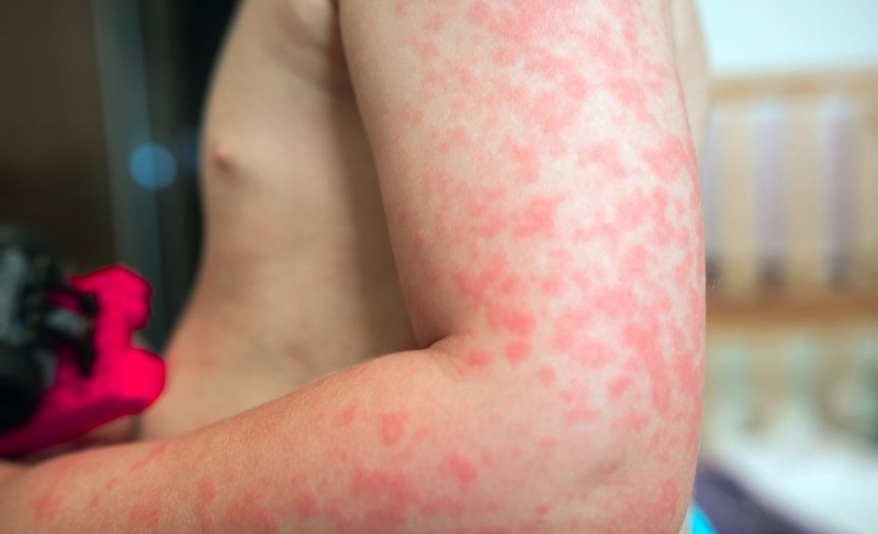 Cảnh giác với một số tác dụng phụ của bí ngòi 2