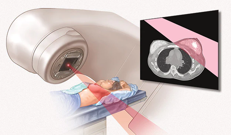 Xạ trị vùng ngực bệnh nhân ung thư vú