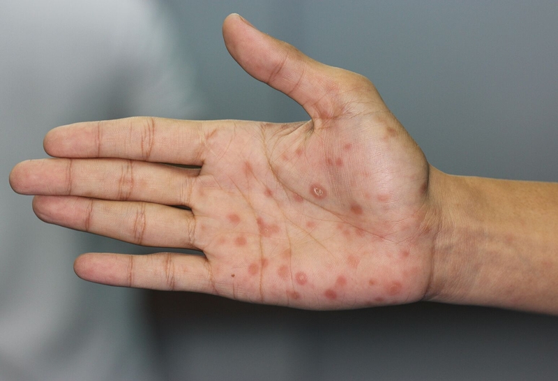 Tác hại của bệnh giang mai rất nguy hiểm, không nên chủ quan 1