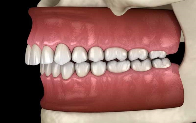 Tác hại của lệch khớp cắn là gì? Lệch khớp cắn ảnh hưởng thế nào tới thẩm mỹ khuôn mặt? 3