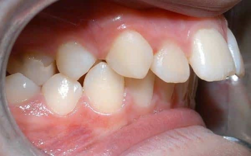 Tác hại của lệch khớp cắn là gì? Lệch khớp cắn ảnh hưởng thế nào tới thẩm mỹ khuôn mặt? 5