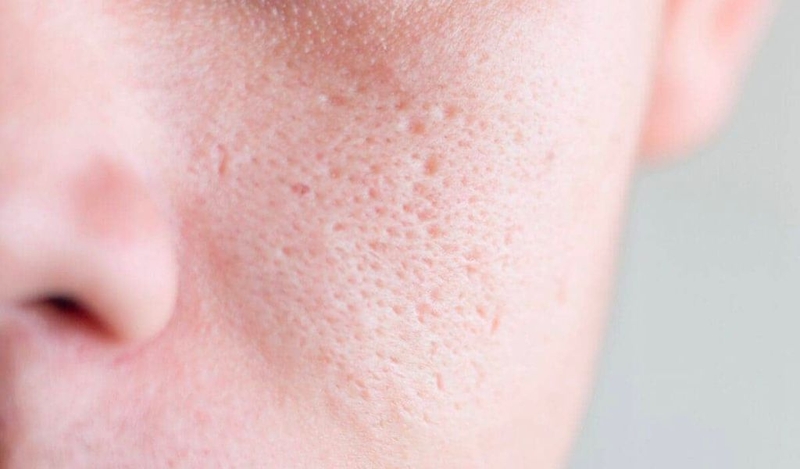 Tác hại của máy hút mụn mà bạn nên biết trước khi sử dụng 2