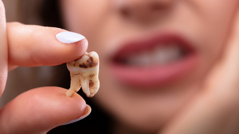 Tiêu chân răng có thể xảy ra khi răng chịu lực chỉnh nha trong thời gian dài
