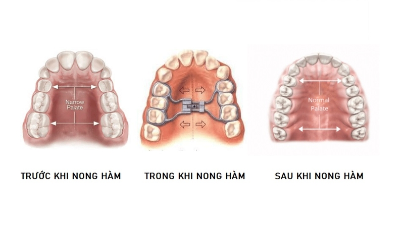 Thực hư về tác hại của nong hàm trong chỉnh nha 1