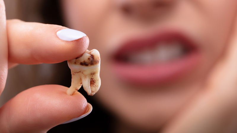 Tác hại của sâu răng là gì? Cách chăm sóc sâu răng tại nhà hiệu quả 2