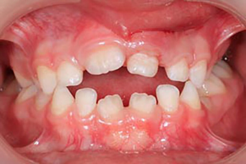 Tác hại của tật đẩy lưỡi là gì? 1