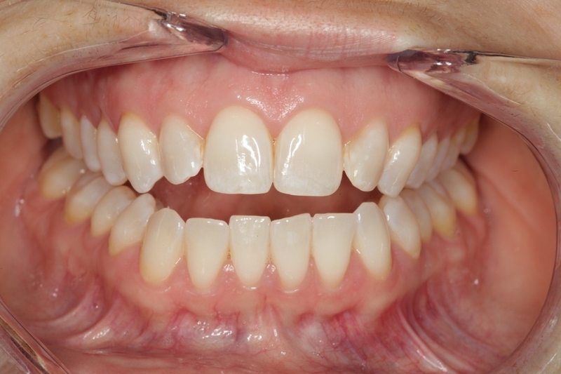 Tác hại của tật đẩy lưỡi là gì? 2