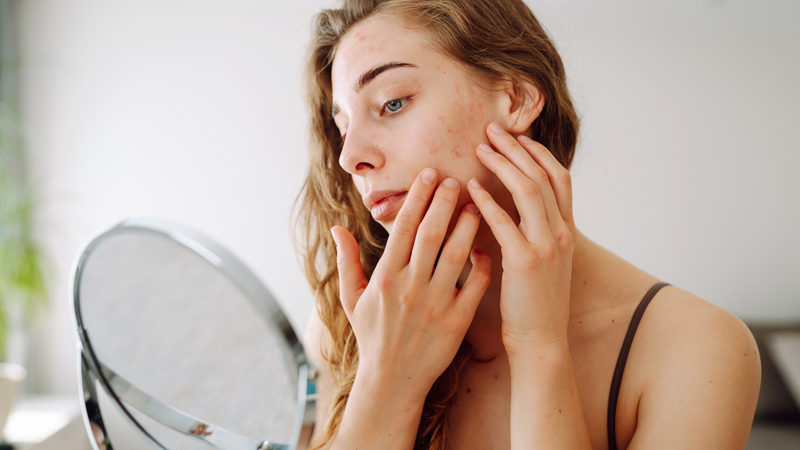 Bùng phát mụn trứng cá