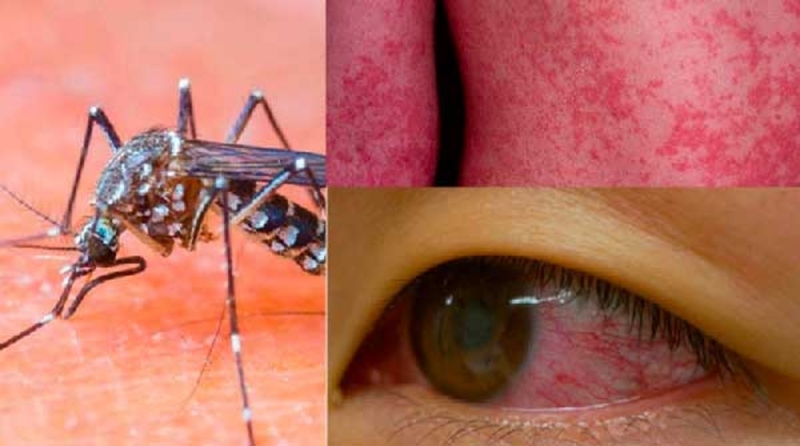 Tác hại của virus zika đối với cơ thể là gì? Biểu hiện nhiễm virus zika 3