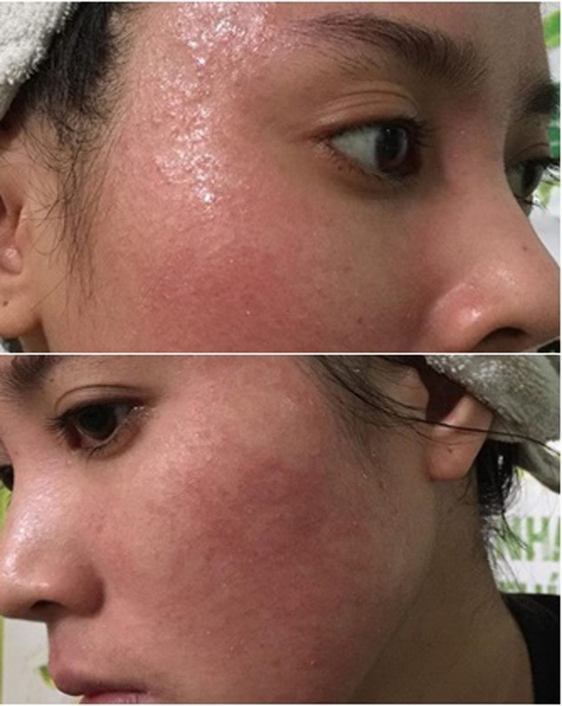 Tác hại không lường của việc tẩy trắng da quá mức4