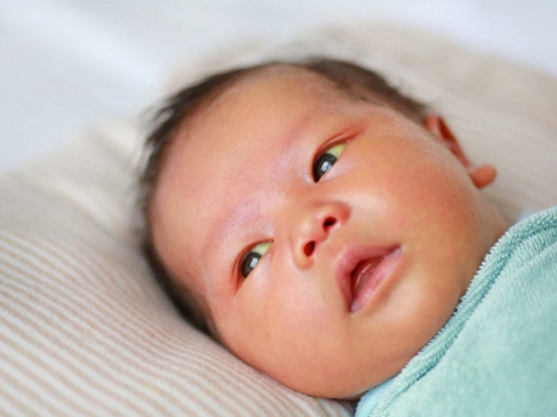 Tắc lệ đạo bẩm sinh: Nguyên nhân, triệu chứng, cách chẩn đoán và điều trị bệnh 2