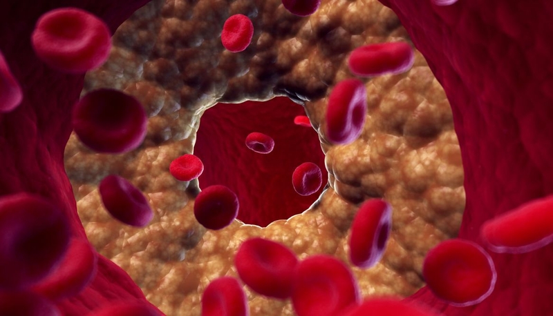 Tắc mạch máu có chữa được không? Đâu là cách điều trị hiệu quả 1