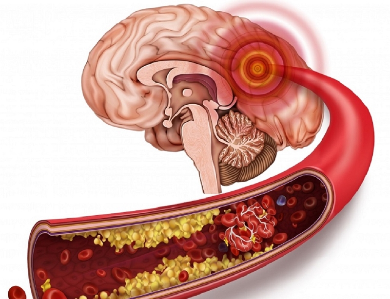 Tắc mạch máu não có nguy hiểm không? Các biện pháp phòng ngừa bệnh tắc mạch máu não 1