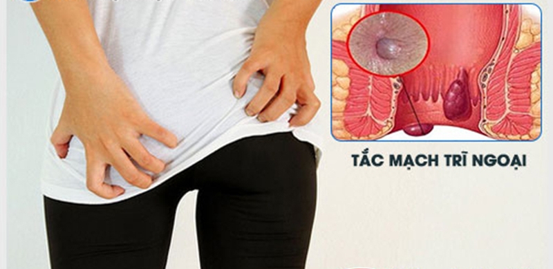 Tác hại của bệnh trĩ mà bạn nên biết 3