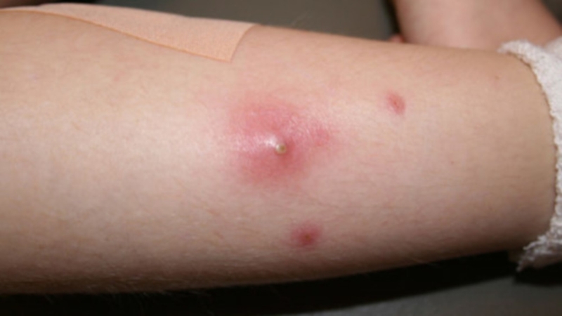 Tắc nghẽn các tuyến mồ hôi: Nguyên nhân, triệu chứng và phương pháp điều trị 1