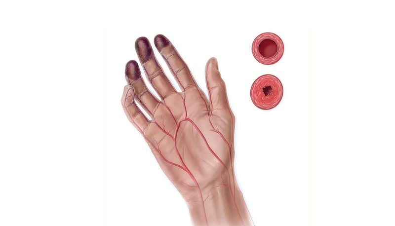 Tắc nghẽn mạch máu ở tay: Nguyên nhân, triệu chứng, cách điều trị 1