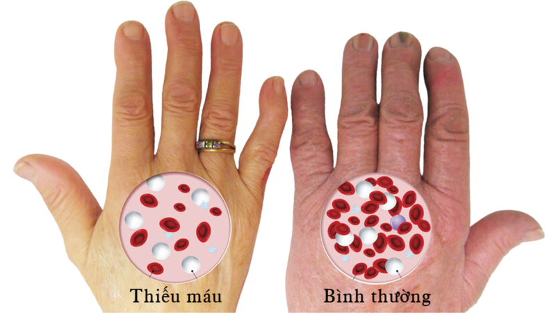 Tác nhân gây bệnh sốt rét là gì? 2