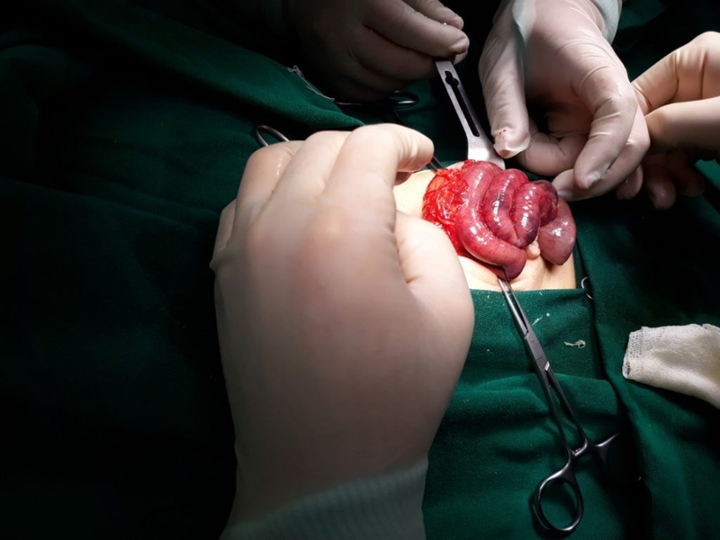 Xoắn ruột là một trong những nguyên nhân gây tắc ruột cơ học