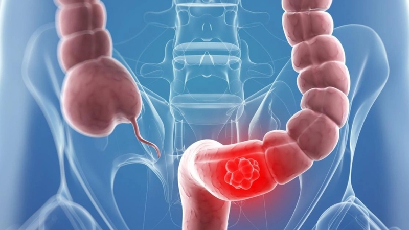 Tắc ruột cơ năng là gì và những điều cần biết 1