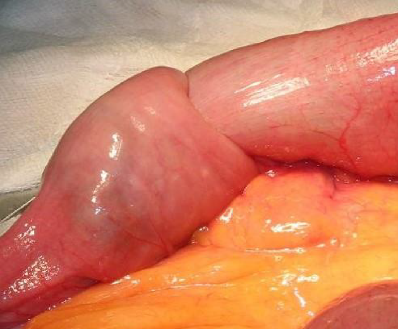 Tắc ruột ở trẻ do nguyên nhân gì? Có nguy hiểm không?