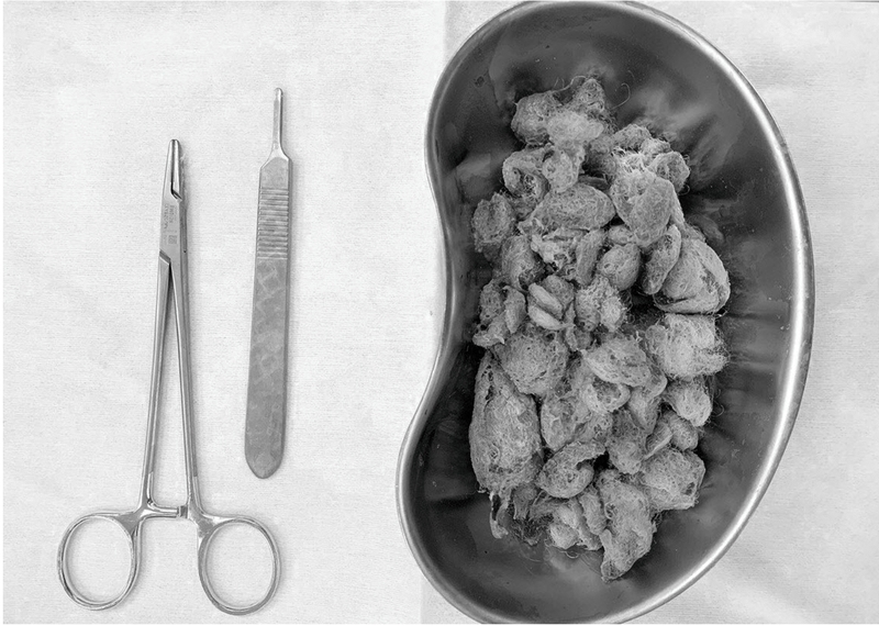 Tắc ruột ở trẻ do nguyên nhân gì? Có nguy hiểm không? 1