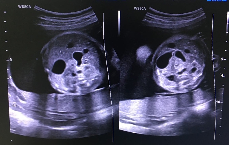 Tắc tá tràng do teo tá tràng bẩm sinh thường xuất hiện sớm sau sinh