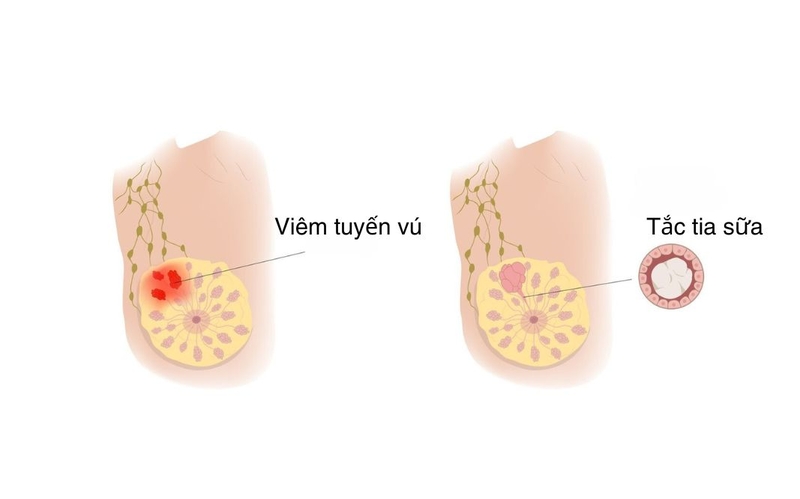 Tắc tia sữa phải làm sao? Hướng dẫn cách xử lý hiệu quả 1