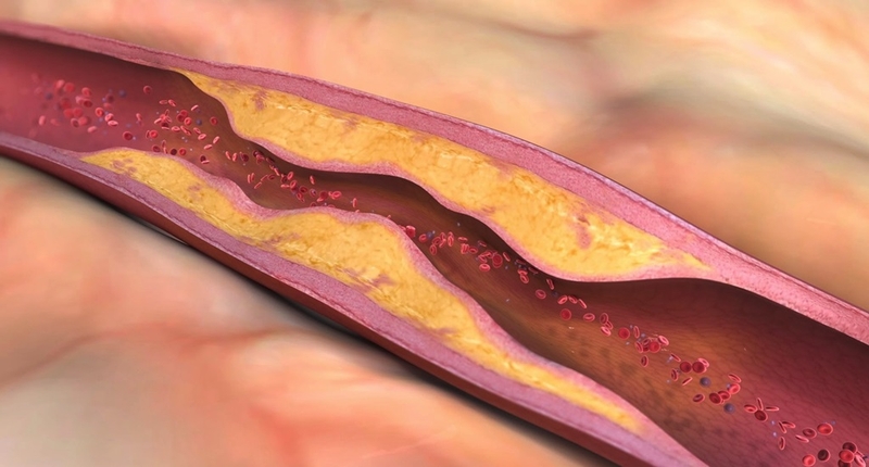 Tắc tĩnh mạch trung tâm võng mạc do nguyên nhân gì? Cách điều trị và phòng tránh 2