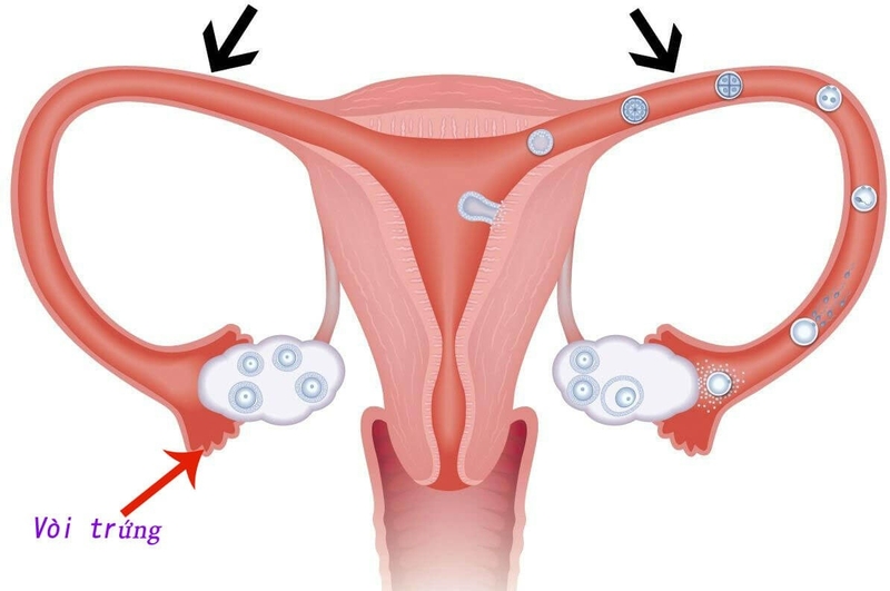 Những dấu hiệu tắc vòi trứng bạn cần biết 1