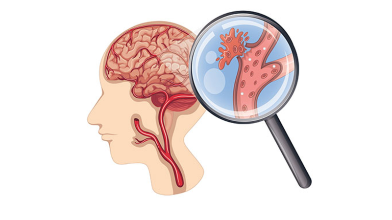 Tai biến mạch máu não vùng thân não 2