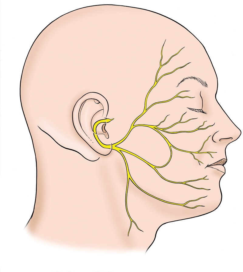 Tai biến méo miệng do liệt dây thần kinh số 7 2