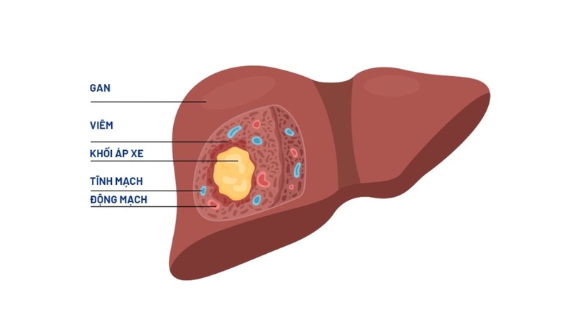 Nhiều người thắc mắc tại sao áp xe gan hay gặp ở thùy phải