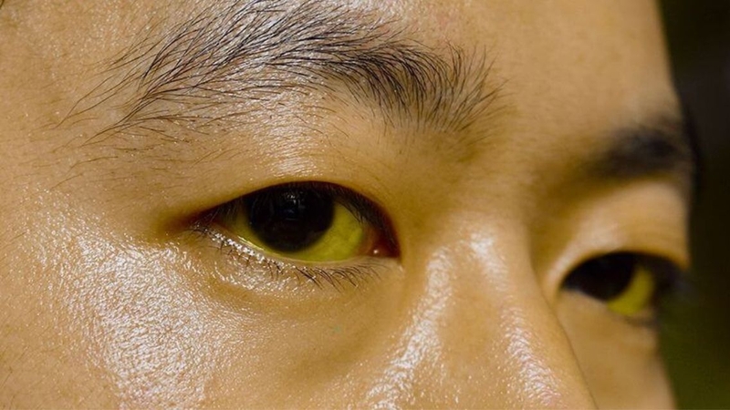 Có thể nhận diện áp xe gan ở thùy phải quá nhiều triệu chứng