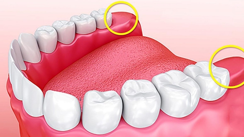 Tại sao bạn lại không mọc răng khôn? Không mọc răng khôn có sao không? 3