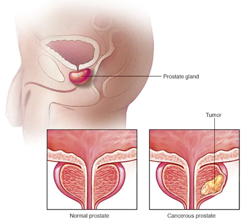 Tại sao bạn nên sàng lọc ung thư tuyến tiền liệt?-1