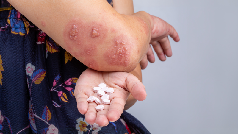 Không nên tự ý mua thuốc điều trị giời leo tại nhà