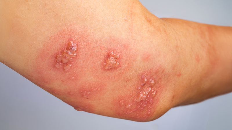 Kiêng nước tuyệt đối khi bị giời leo khiến da khô, nứt nẻ, dễ nhiễm trùng