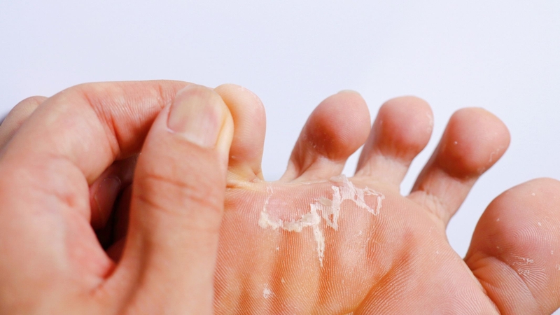 Vệ sinh và thói quen sinh hoạt chưa đúng cách làm tăng tích tụ vi khuẩn và tế bào chết