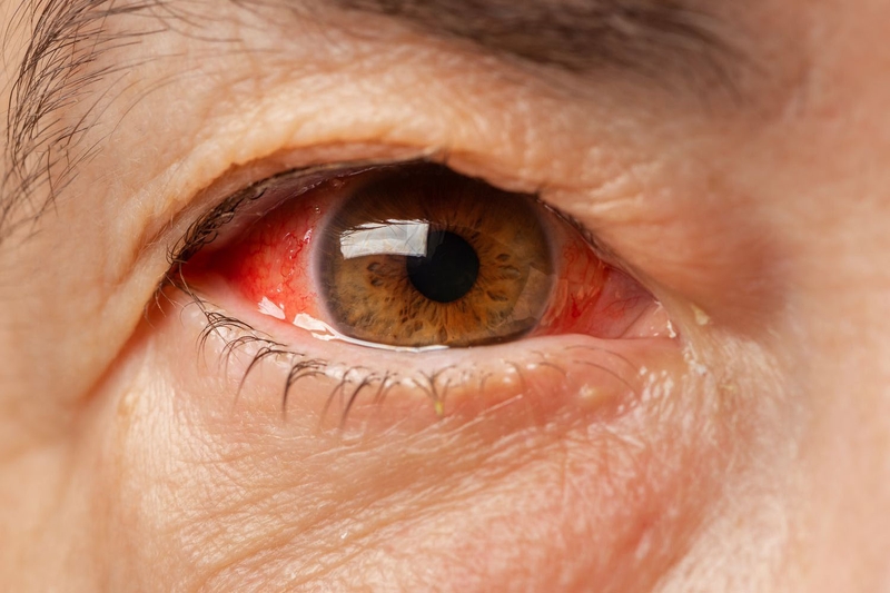 Tại sao bị ngứa khóe mắt? Mẹo làm dịu cơn ngứa nhanh chóng