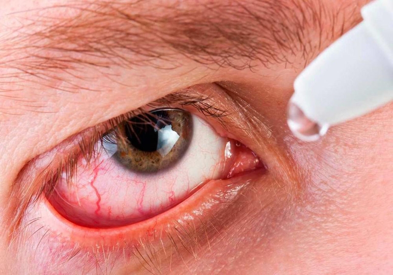 Tại sao bị ngứa khóe mắt? Mẹo làm dịu cơn ngứa nhanh chóng