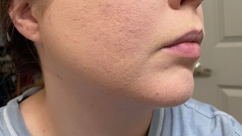 Khuôn mặt mốc trắng sau khi bôi kem chống nắng nhìn rất mất thẩm mỹ