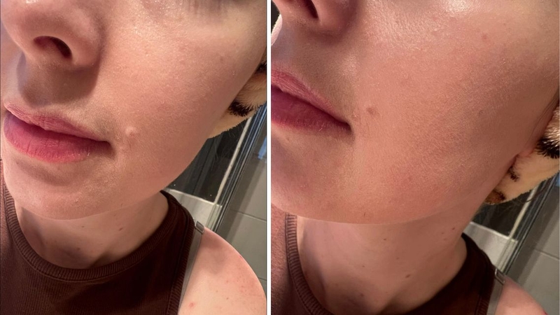 Liệu có cách nào hạn chế tình trạng da bị mốc khi bôi kem chống nắng không?