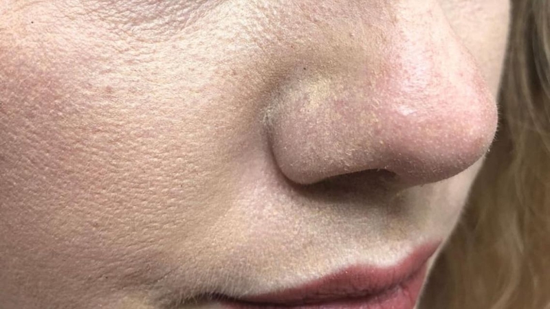 Nhiều người còn chưa biết&nbsp;tại sao bôi kem chống nắng bị mốc