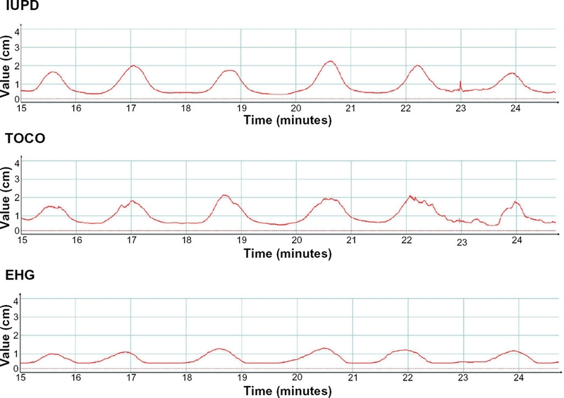 Tại sao cổ tử cung mở 1cm nhưng không đau bụng? Làm thế nào để cổ tử cung mở nhanh? 3